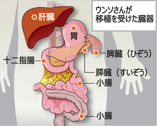 7歳の少女、臓器七つの同時移植に成功