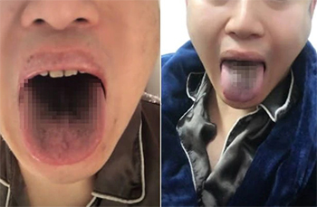 ▲新型コロナウイルス感染が判明した後、舌が黒くなったと主張する天津市内の男性。写真＝ウェイボー（微博）より