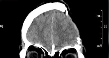 ▲頭蓋骨の左側の除去手術を受けた後のウ・ウンビンさんのレントゲン写真。／MBC『心臓を鳴らせ　講演者たち』