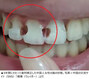 5年ぶりに歯列矯正装置を外した女性（20）、残念すぎる結果が話題に　／中国・遼寧省